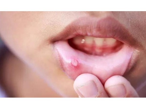 口腔潰瘍吃維C有用嗎？