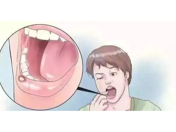 口腔潰瘍反反復(fù)復(fù)，補(bǔ)充維C就能好？